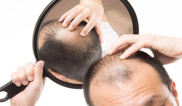 تساقط الشعر
