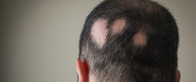 علاجات الثعلبة